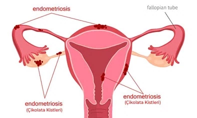 Endometriozis (Çikolata Kisti) Ameliyatı
