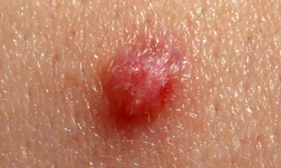 genital siğil (hpv) belirtileri