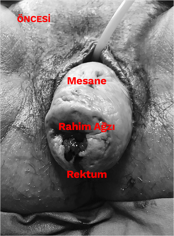Rahim Sarkması Ameliyatı Öncesi