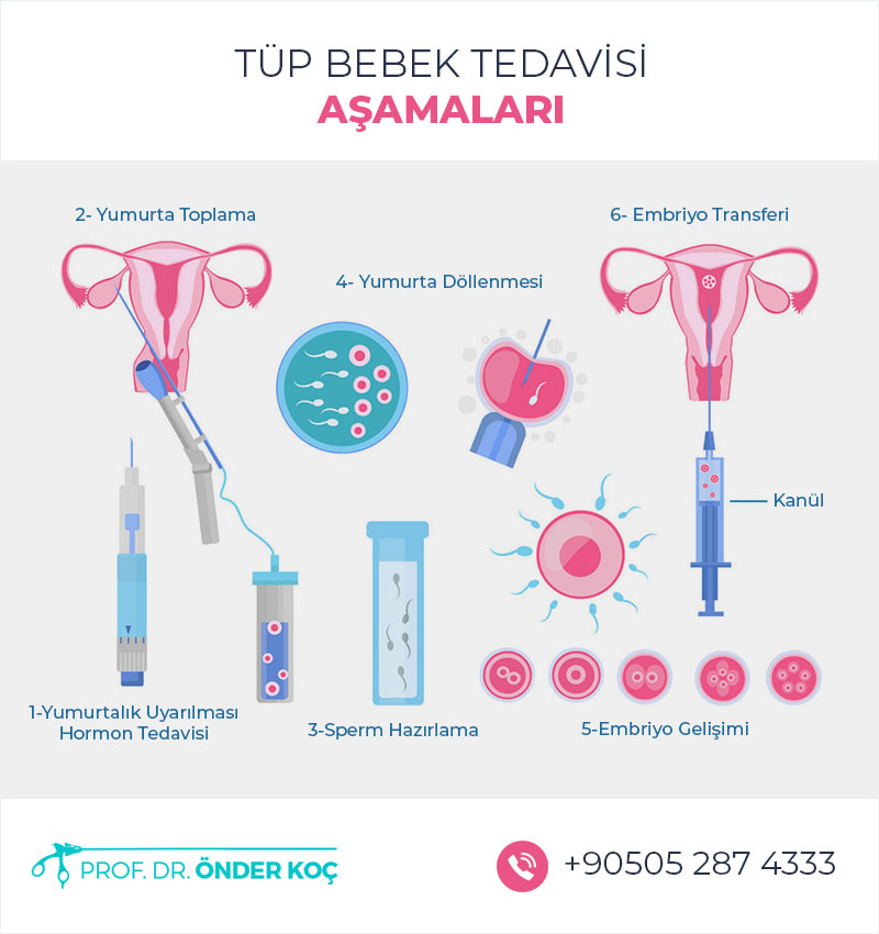 Tüp Bebek Tedavisi Aşamaları