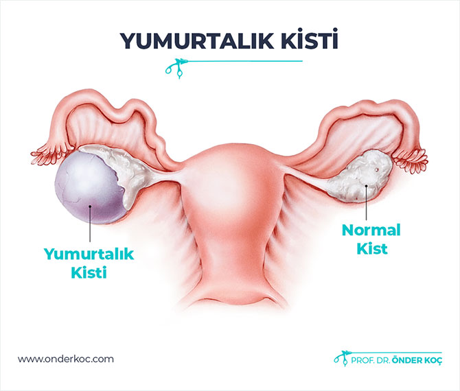 yumurtalık kisti nedir?